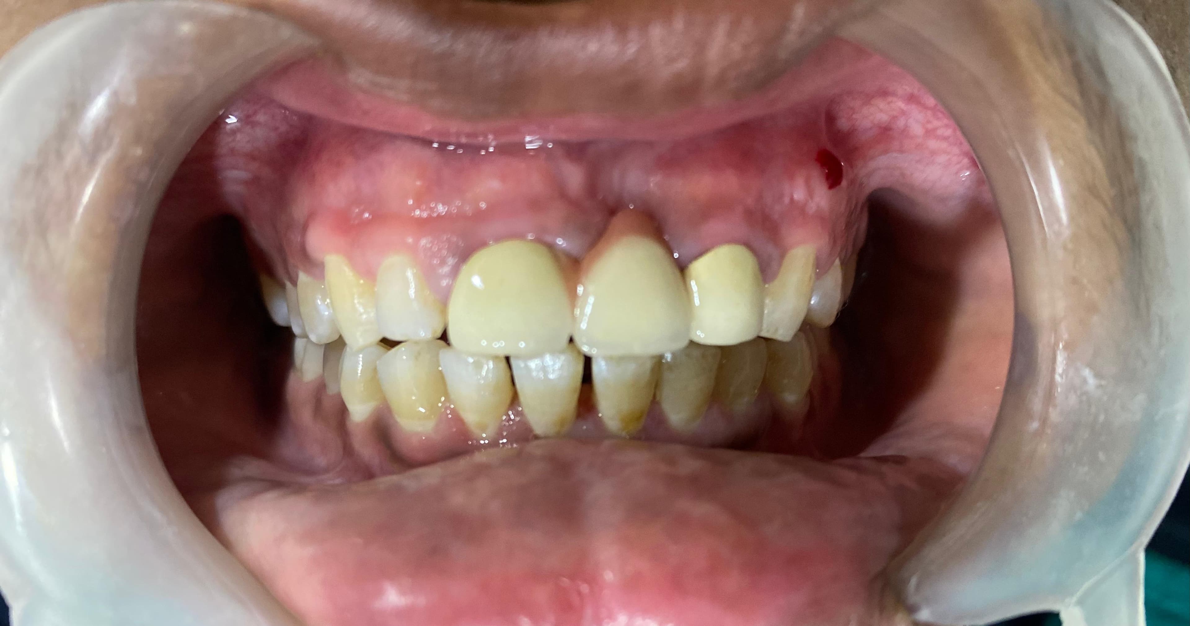 Missing Teeth Replacement — after treatment
