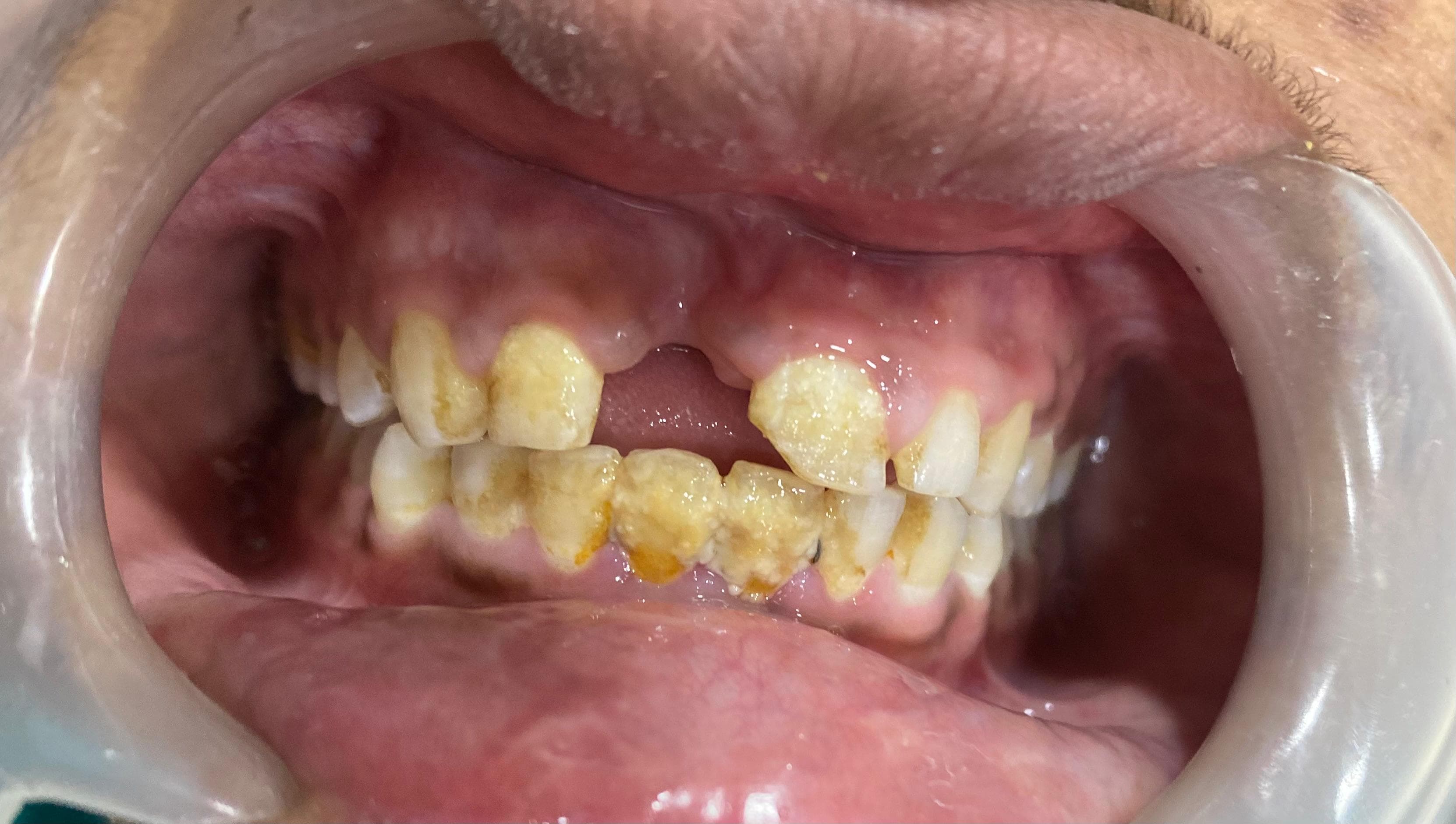 Missing Teeth Replacement — before treatment