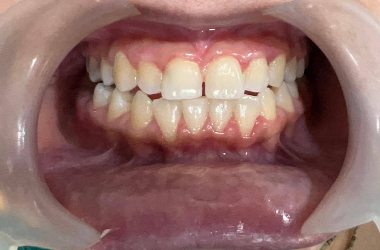Smile Makeover — after treatment
