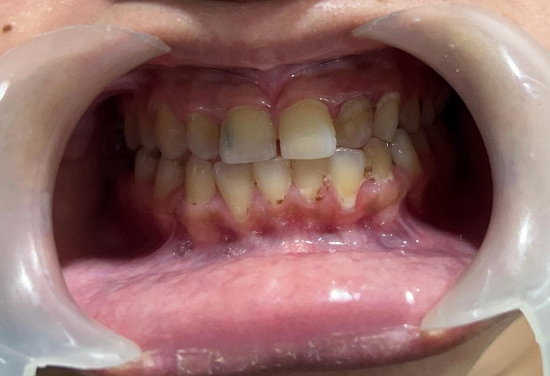 Smile Makeover — before treatment
