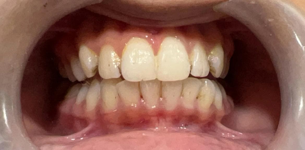 Scaling & Polishing — after treatment