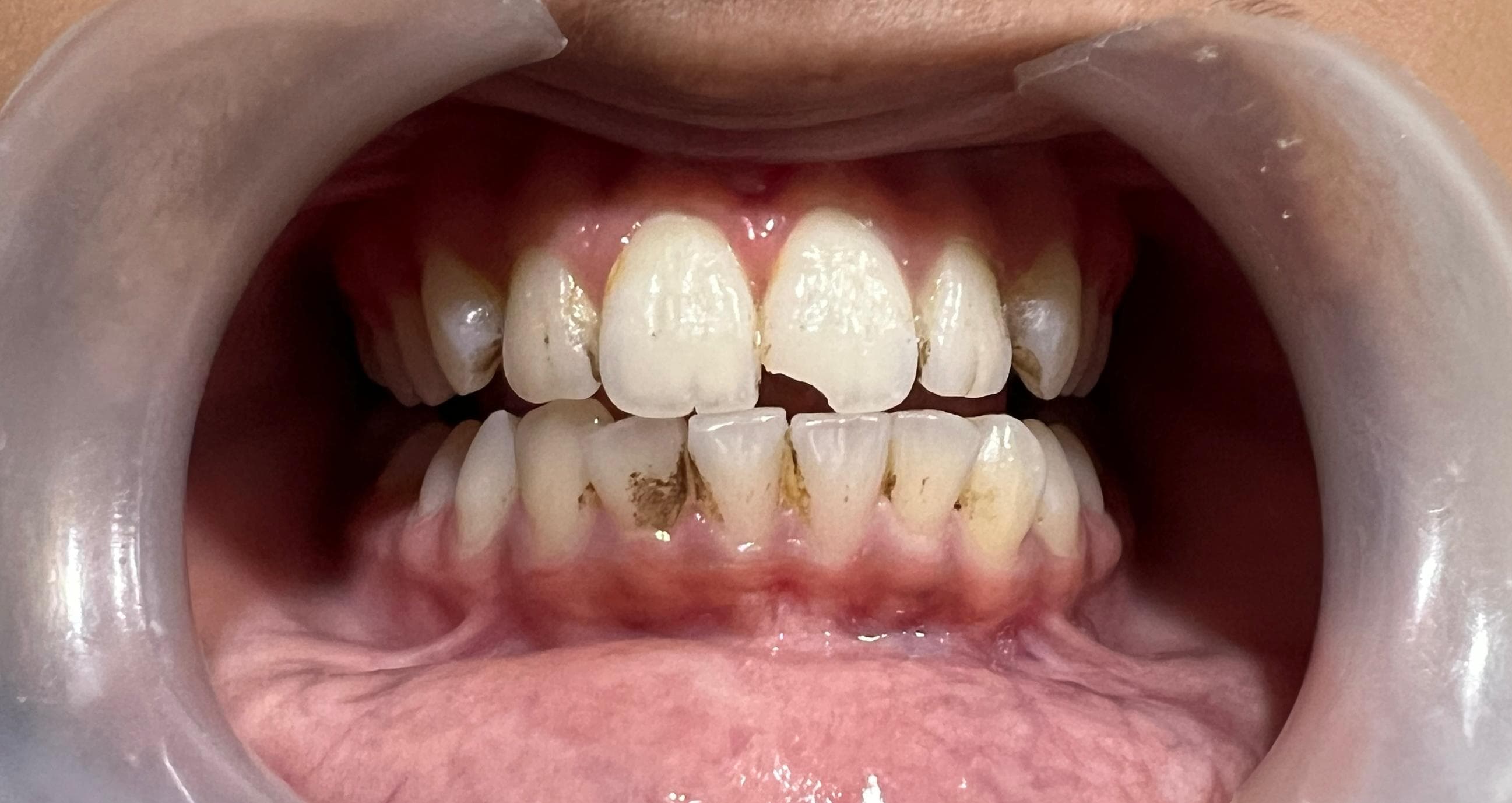 Scaling & Polishing — before treatment