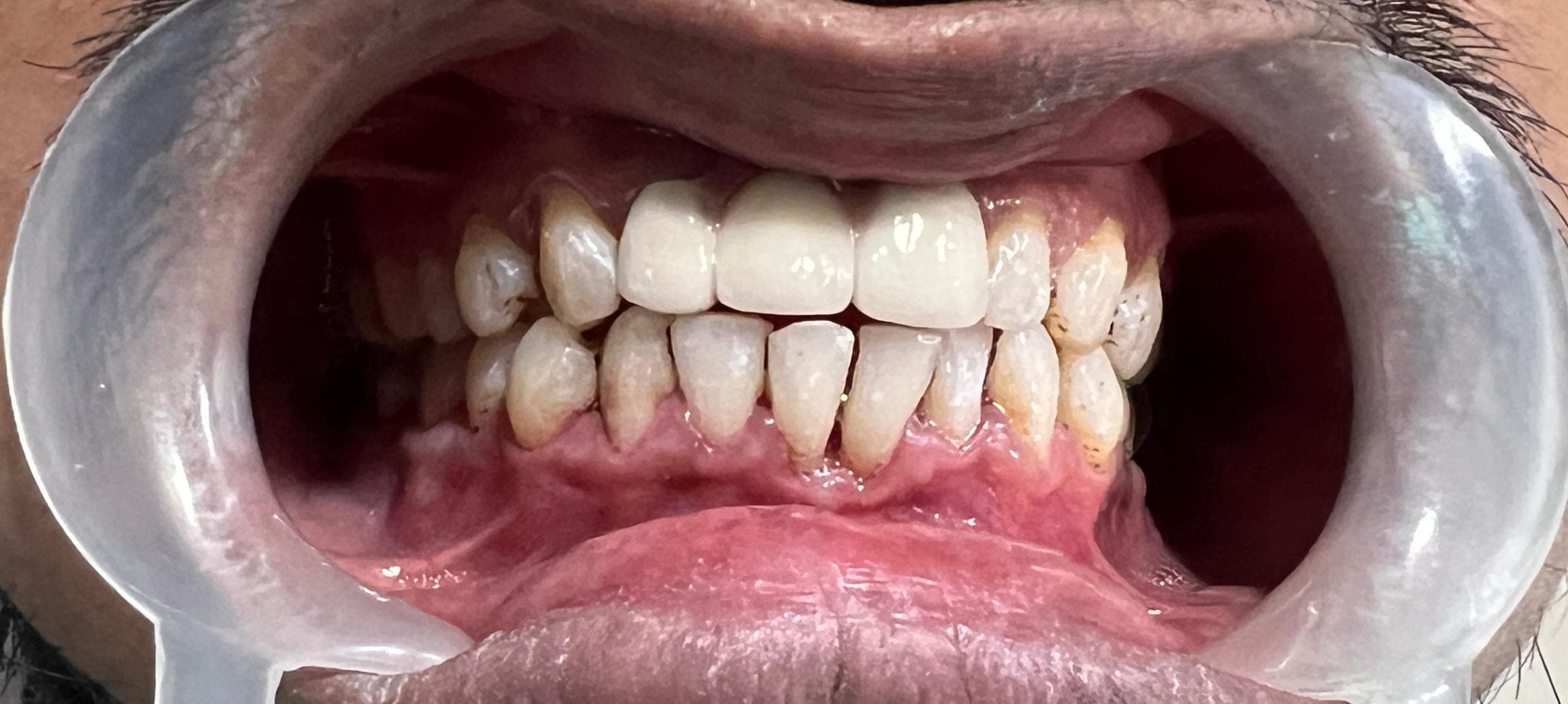 Full-Mouth Rehabilitation — after treatment