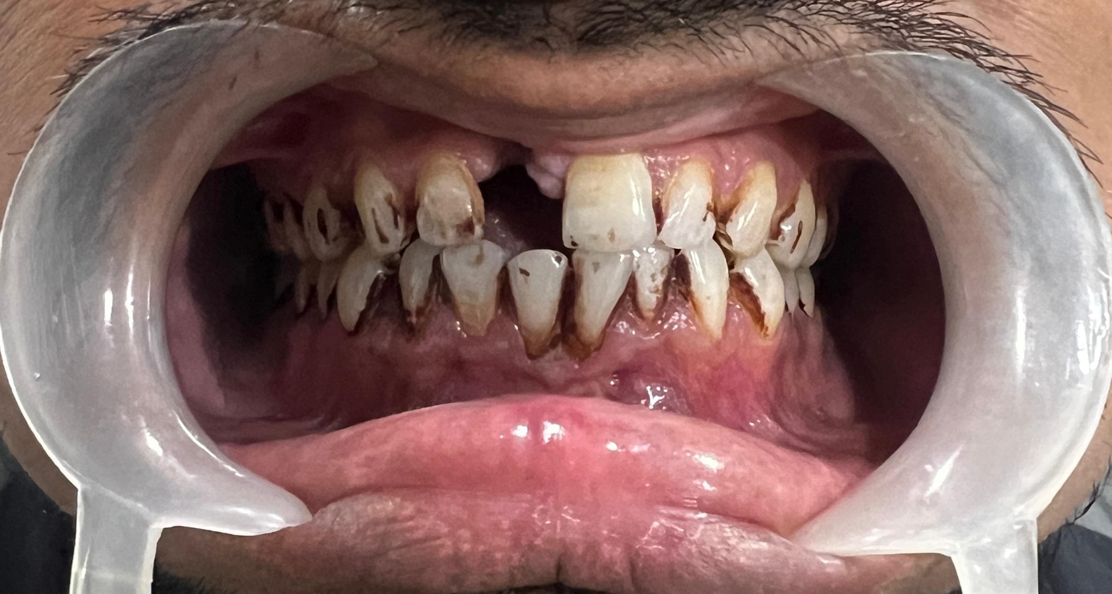 Full-Mouth Rehabilitation — before treatment
