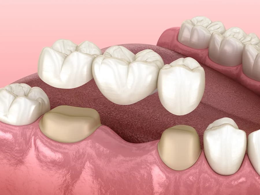 Dental Bridges