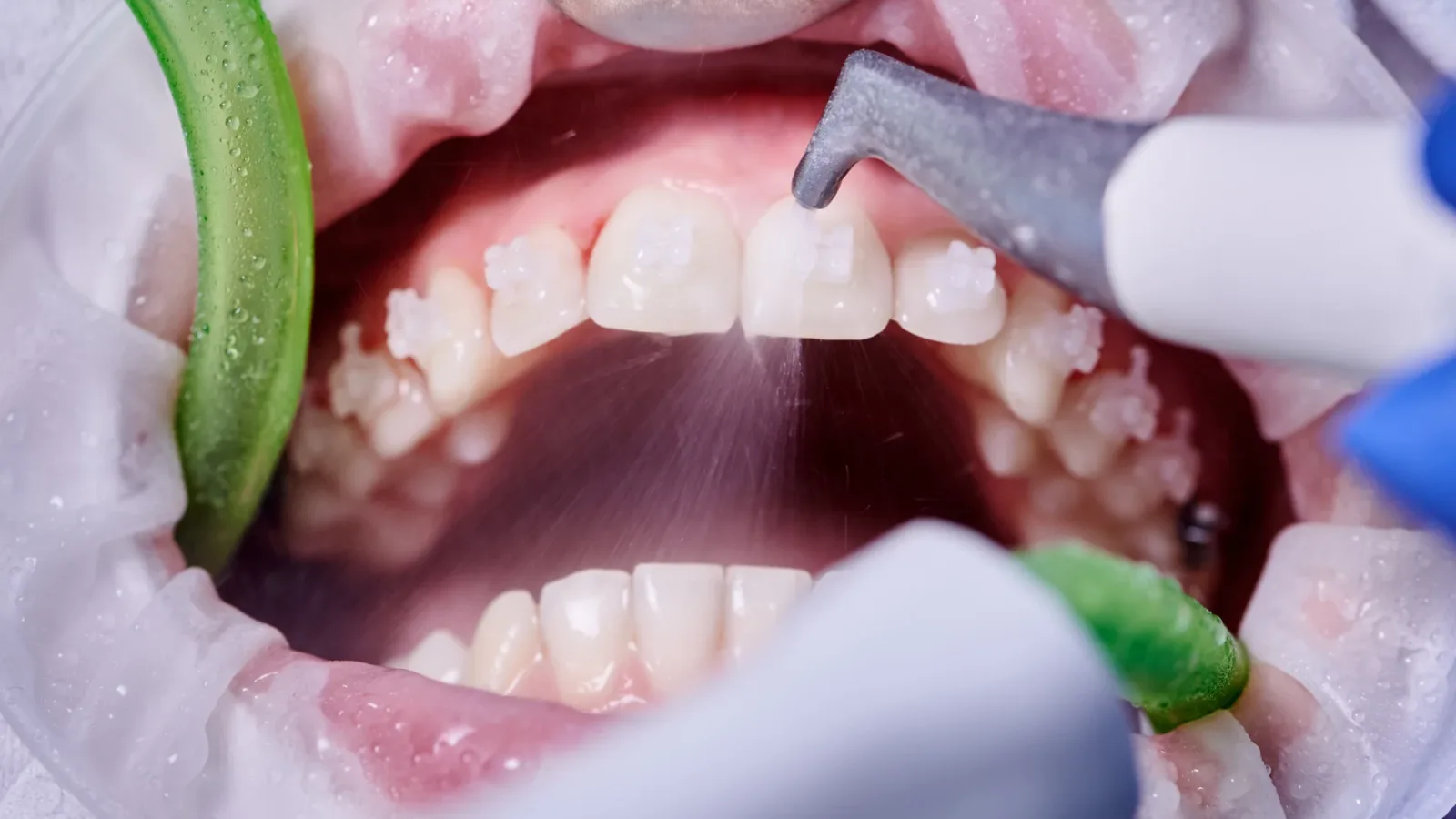 Dental Fillings