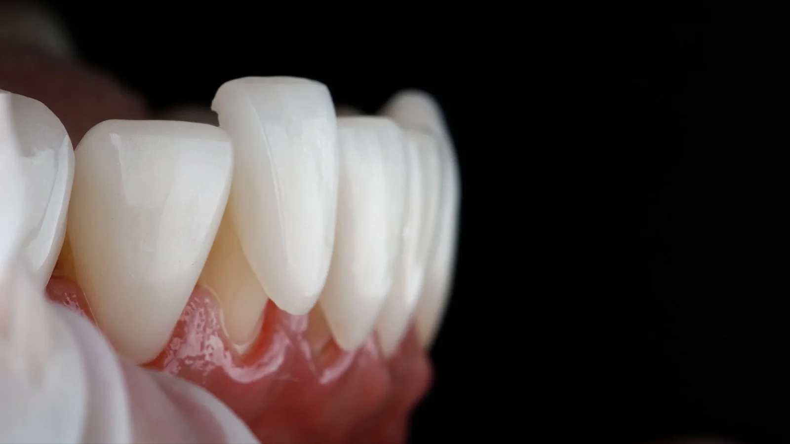 Ceramic Veneers & Crowns
